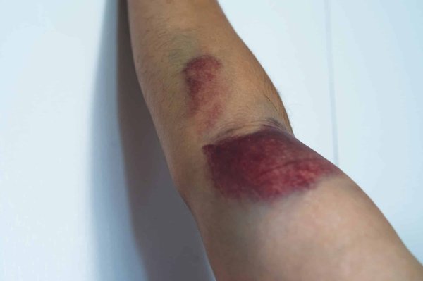 Inflammation : quels sont les points clés à connaître sur ce processus ?