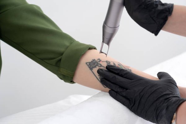 Effacez vos tatouages : laser de détatouage à bordeaux